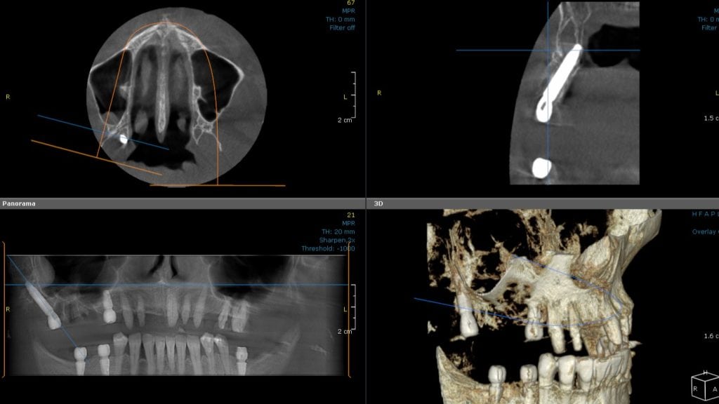 Follow-up CBCT scan: Pterigoid implant as a solution for bone deficiency in the upper jaw.