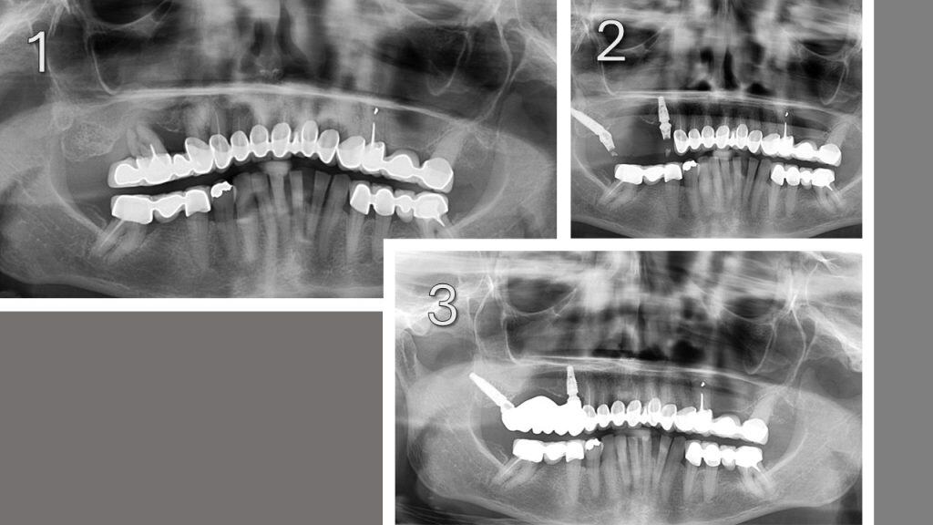 Pterigoid implant in the bridge to avoid a sinus lift.