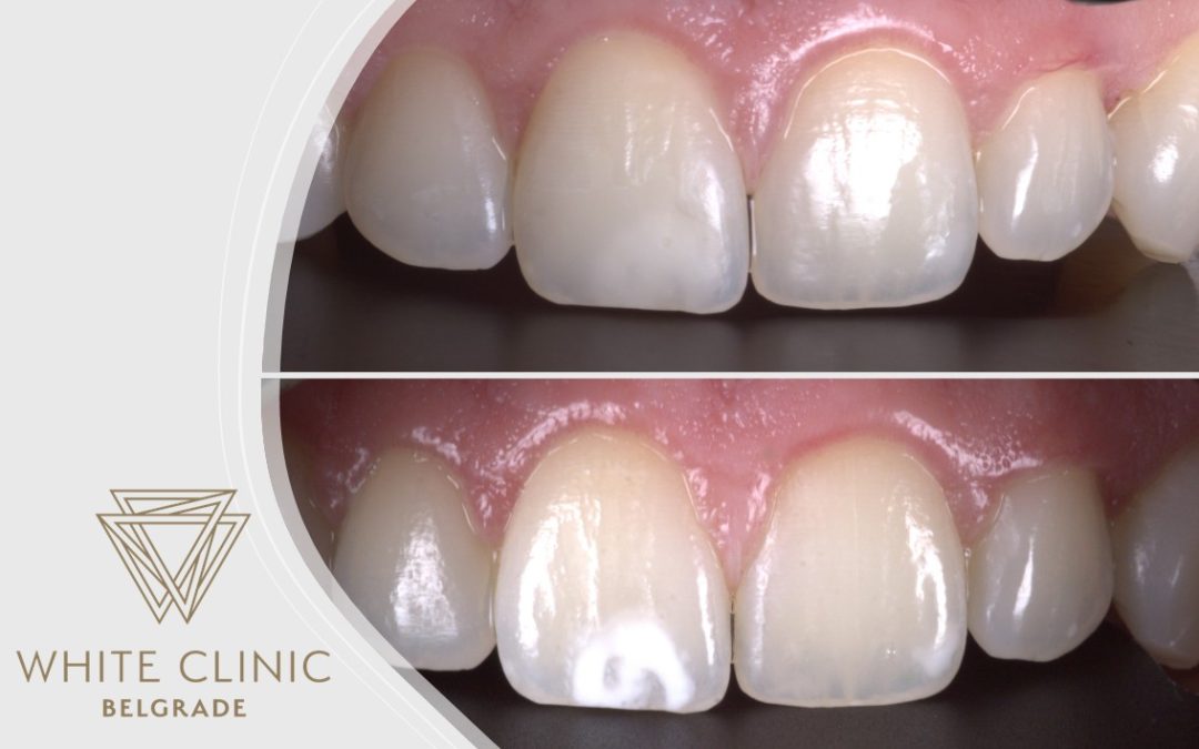 ICON – Savremeno rešenje za bele mrlje na zubima bez bušenja