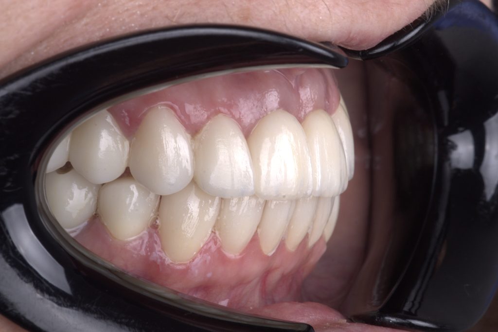 Bezmetalna keramika na zubima i implantatima uz postignut idealan profil desni - White Clinic Belgrade Even in large reconstructions, harmony between the implants and soft tissue can be achieved.