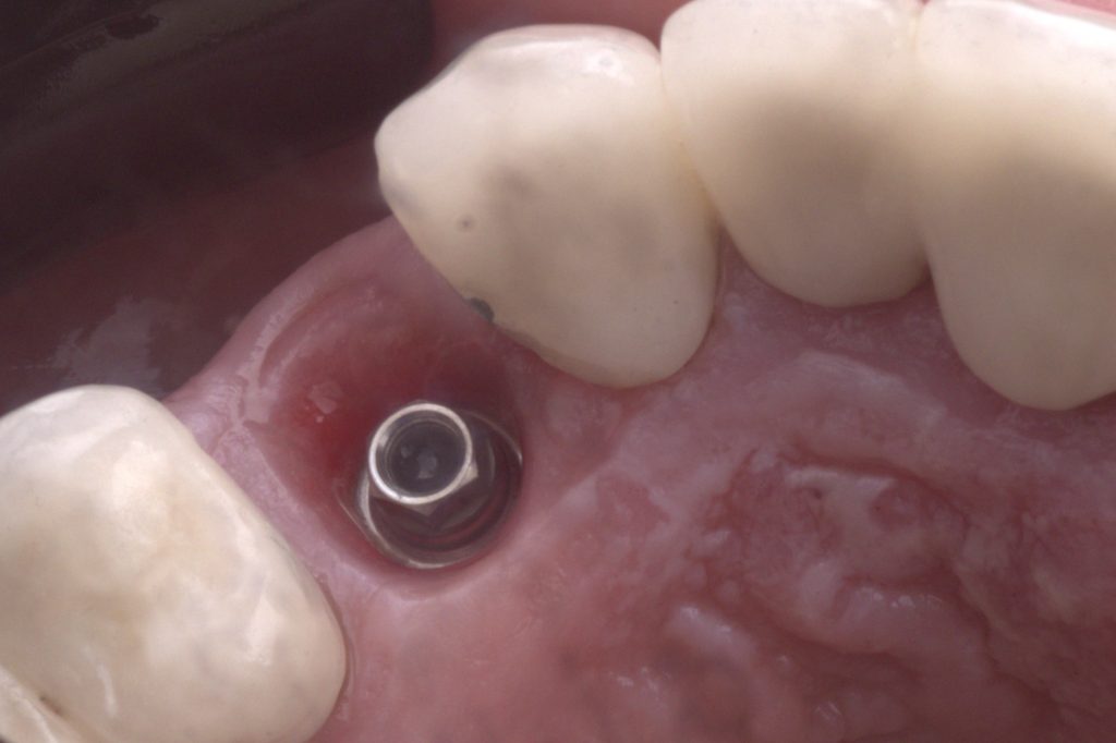 Izlazni profil pokazuje zdravlje mekih tkiva nakon zarastanja - White Clinic Belgrade Emergence profile of flapless immediate implant placement after healing