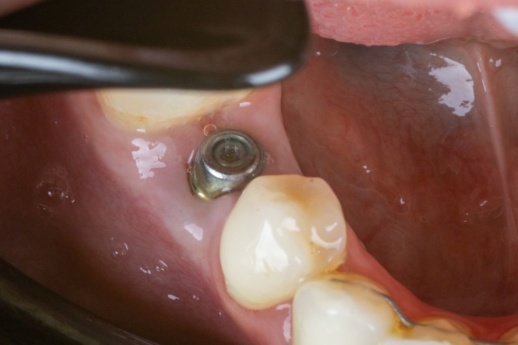 Zarastanje desni oko implantata, postavljenog bez reza - White Clinic Belgrade A week after flapless immediate implant placement.