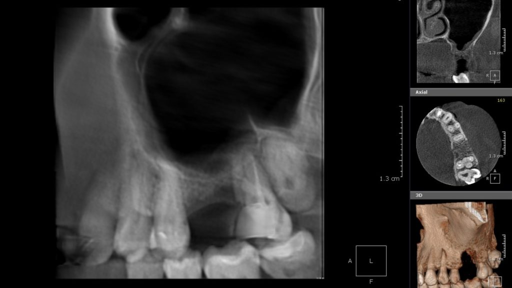 1 CBCT preop - White Clinic Belgrade Panoramic dental X-ray with multiple smaller CBCT panels showing axial, cross‑sectional, and 3D views of the lower jaw and teeth, including a crown and bone around molars.