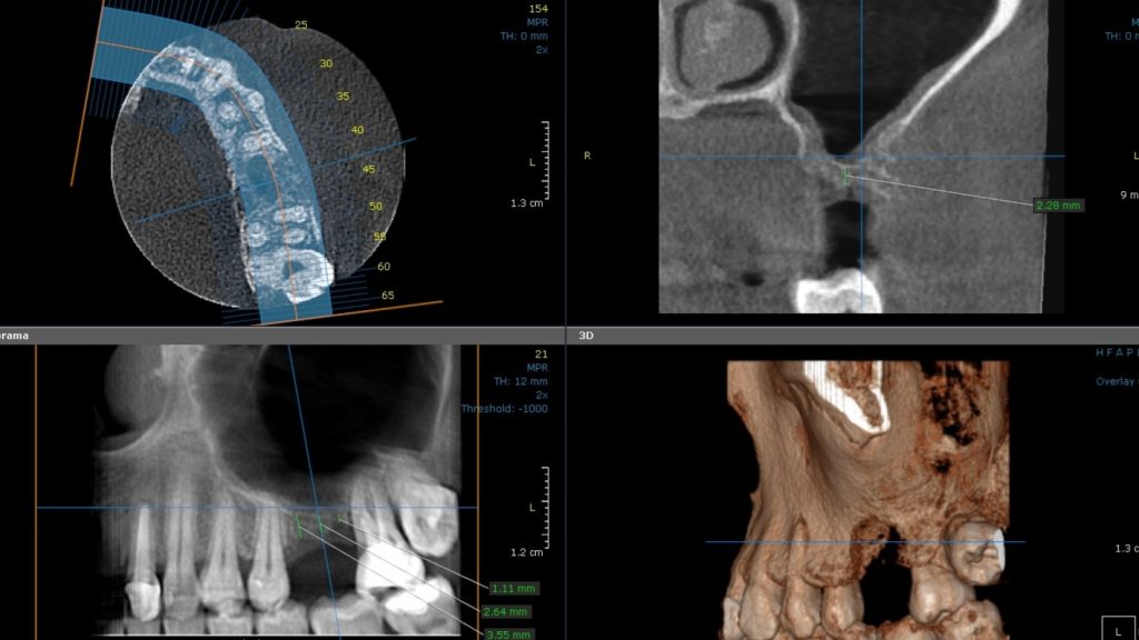 2 CBCT preop with measurements - White Clinic Belgrade CBCT dental imaging screen with four views: axial/3D overlay (top-left), sagittal cross-section with a measurement (top-right), panoramic-like view (bottom-left), and a 3D rendering of teeth and jaw (bottom-right).