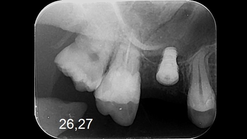 3 - postop - White Clinic Belgrade Dental X-ray of the upper left jaw showing multiple teeth, with the tooth numbers 26 and 27 visible in the image.