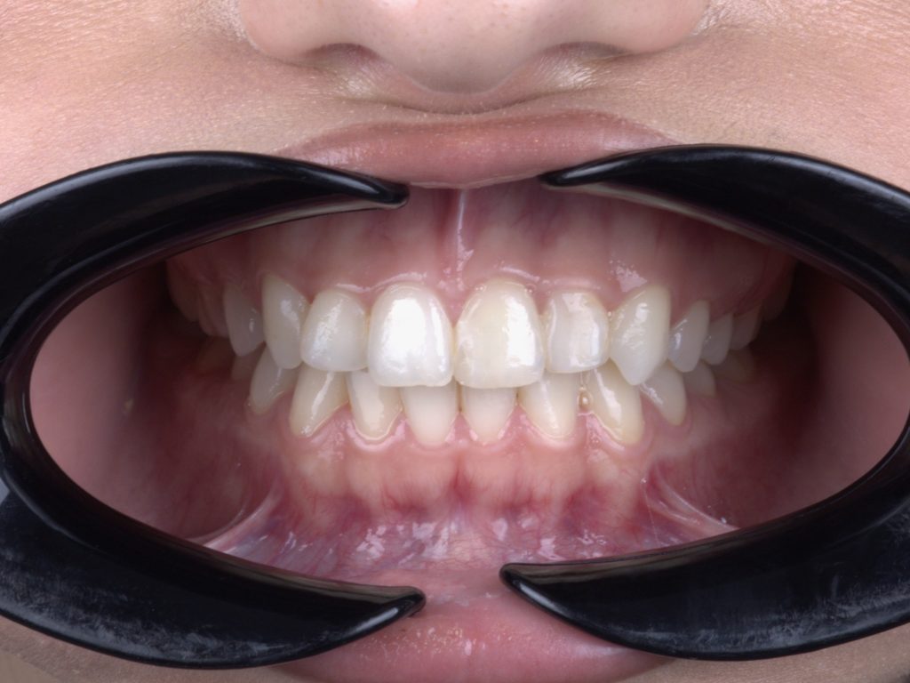 4 - White Clinic Belgrade Close-up of mouth with black lip retractors pulling lips apart to reveal upper and lower teeth in a dental exam setting.