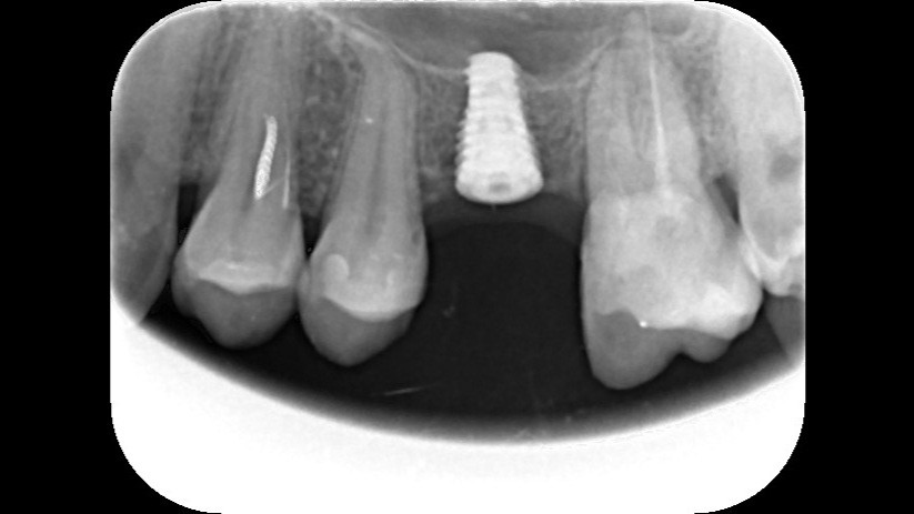 4 - After healing preprosthetic - White Clinic Belgrade