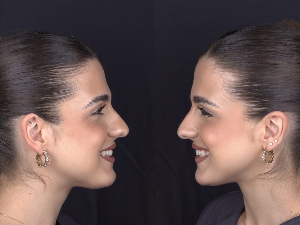 Side by side photo - White Clinic Belgrade Two mirrored profile portraits of a woman with dark hair and gold hoop earrings against a black background, facing opposite directions.